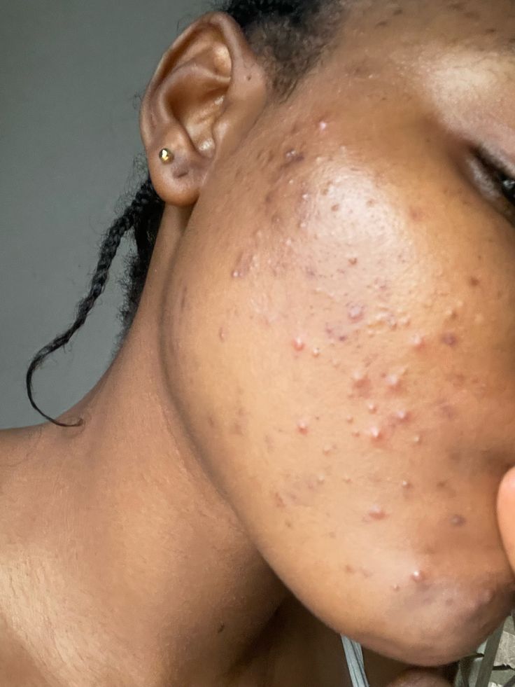 The Clear Skin Blueprint – Part 1